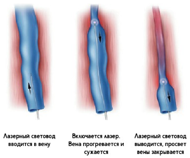 Эндовазальная лазерная коагуляция
