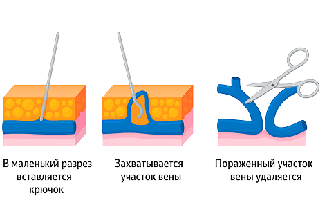 Минифлебэктомия
